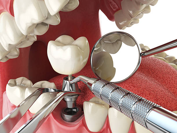 Best Emergency Dentist for Lost Fillings or Crowns in Brush Prairie, WA